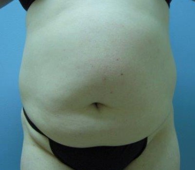Liposuction before and after - before