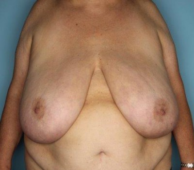 Procedure before and after - before