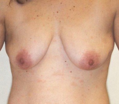 Breast Augmentation before and after - before
