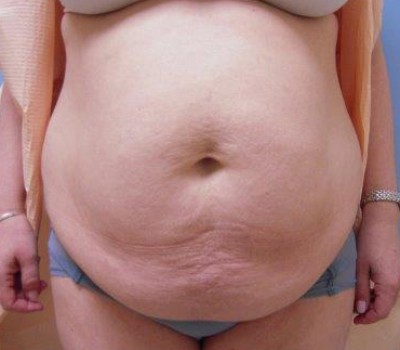 Liposuction before and after - before