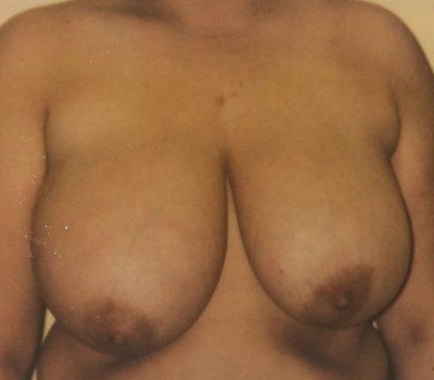Breast Lift before and after - before