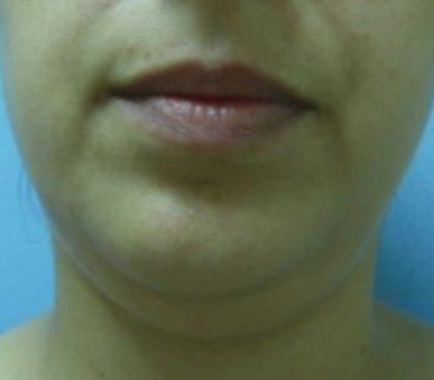 Liposuction before and after - before