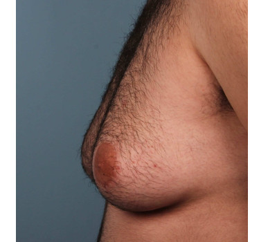 Procedure before and after - before