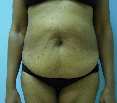 Liposuction before and after - before