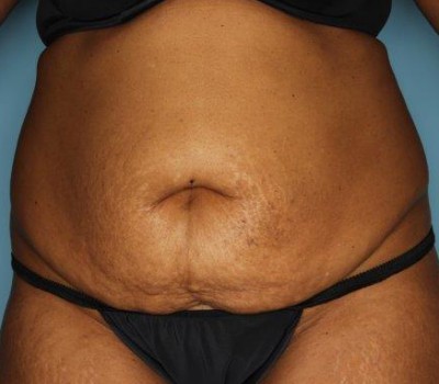 Liposuction before and after - before
