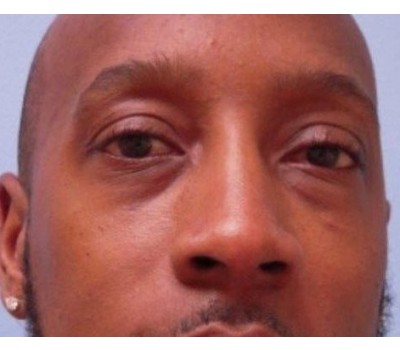 Blepharoplasty before and after - before