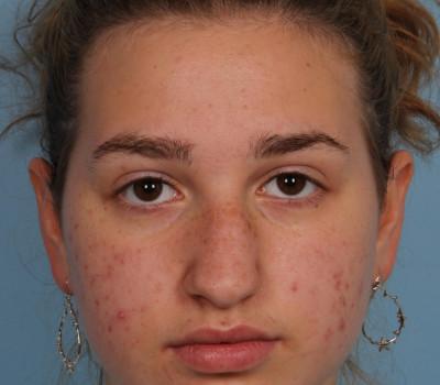 Rhinoplasty before and after - before