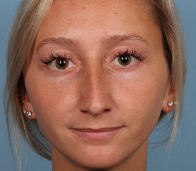 Rhinoplasty before and after - before