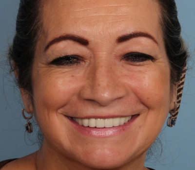 Blepharoplasty before and after - before