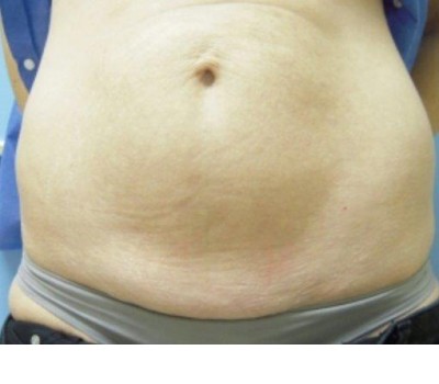 Liposuction before and after - before