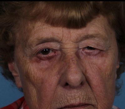 Blepharoplasty before and after - before