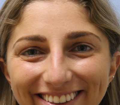 Rhinoplasty before and after - before