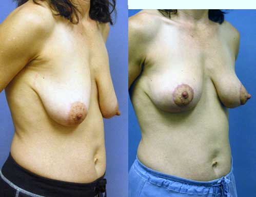 Breast Lift - Mastopexy by Dr. Aaron Stone — after