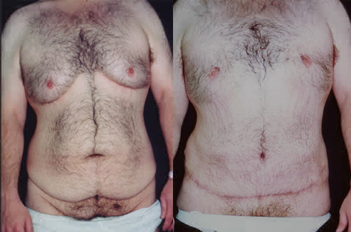 Gynecomastia Excision by Dr. Aaron Stone — after