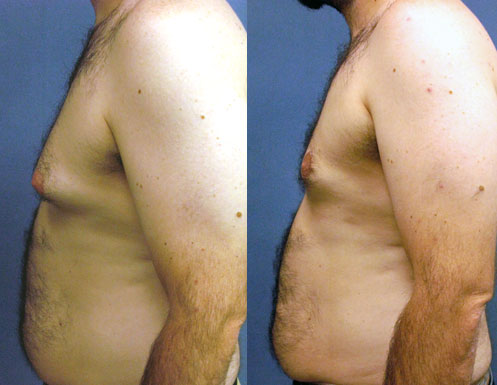 Gynecomastia Excision by Dr. Aaron Stone — after