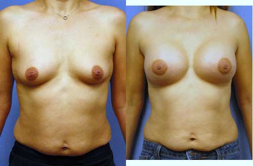 Breast Augmentation by Dr. Aaron Stone — after