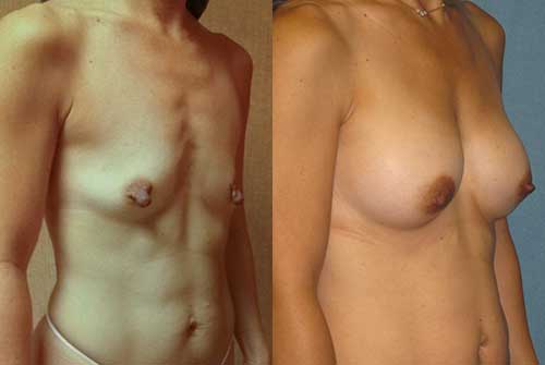 Breast Augmentation by Dr. Aaron Stone — after