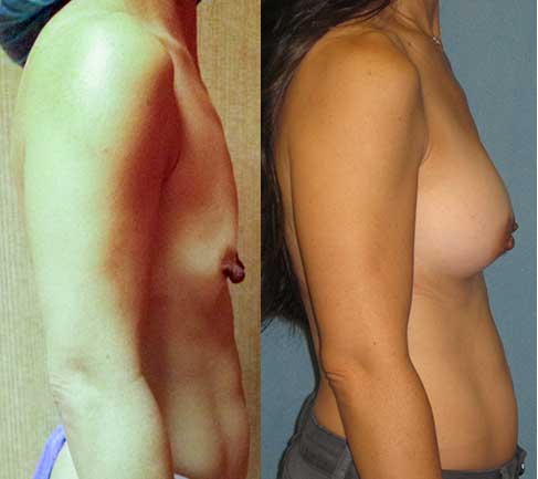 Breast Augmentation by Dr. Aaron Stone — before