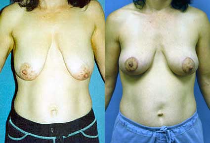 Breast Lift - Mastopexy by Dr. Aaron Stone — before