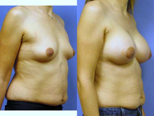 Breast Augmentation by Dr. Aaron Stone — before