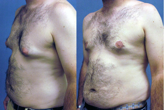Gynecomastia Excision by Dr. Aaron Stone — before