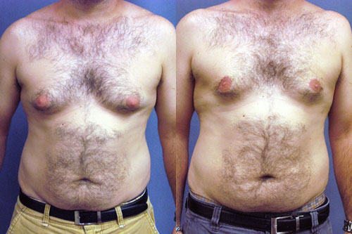 Gynecomastia Excision by Dr. Aaron Stone — before