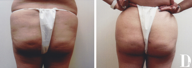 Brazilian Butt Lift before and after - after