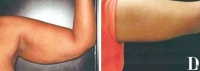 Arm Lift before and after - after