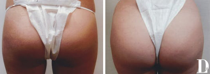 Brazilian Butt Lift before and after - after