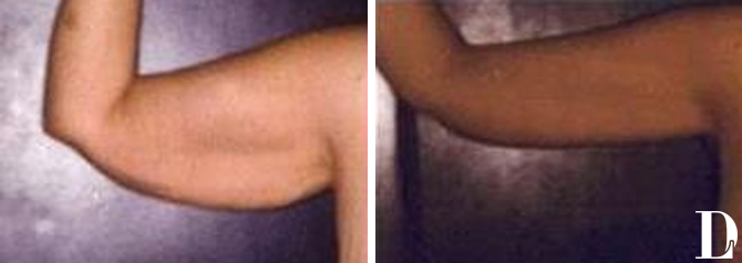 Arm Lift before and after - after