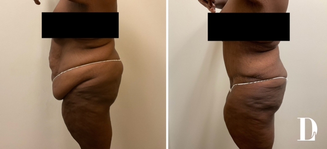 Tummy Tuck before and after - after