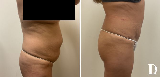 Tummy Tuck before and after - after