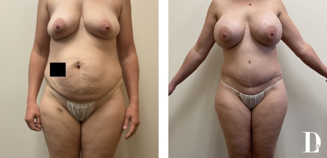 Tummy Tuck before and after - after