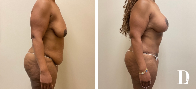 Tummy Tuck, Breast Augmentation, and Mastopexy before and after - after