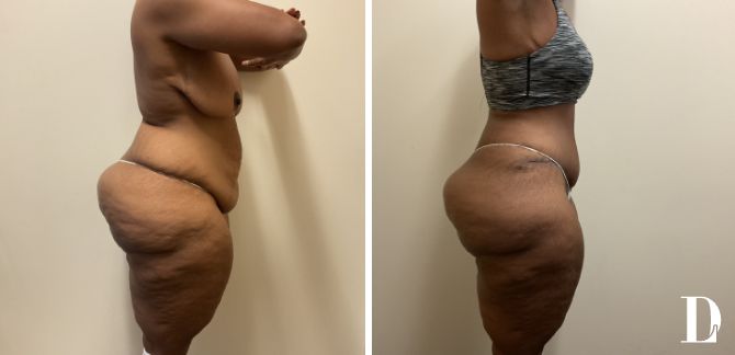 Tummy Tuck and Liposuction before and after - after