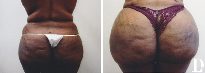 Brazilian Butt Lift before and after - after
