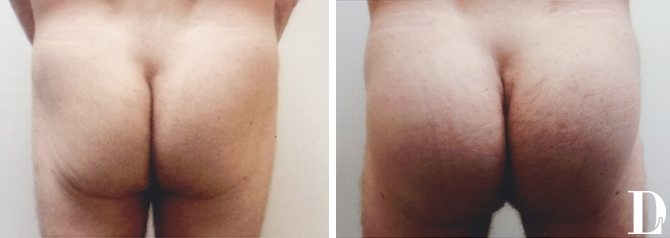Butt Implant Surgery before and after - after