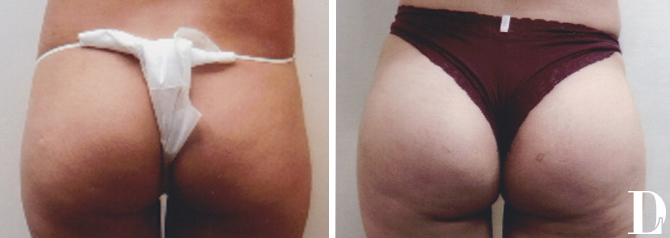 Butt Implant Surgery before and after - after