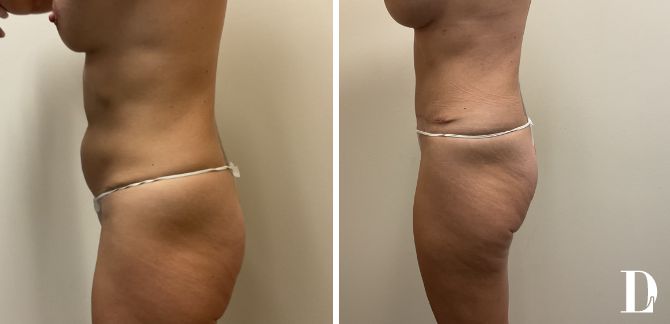 Tummy Tuck & Breast Augmentation before and after - after
