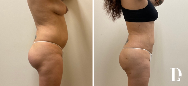 Butt Implant Removal with Liposuction and Fat Transfer before and after - after