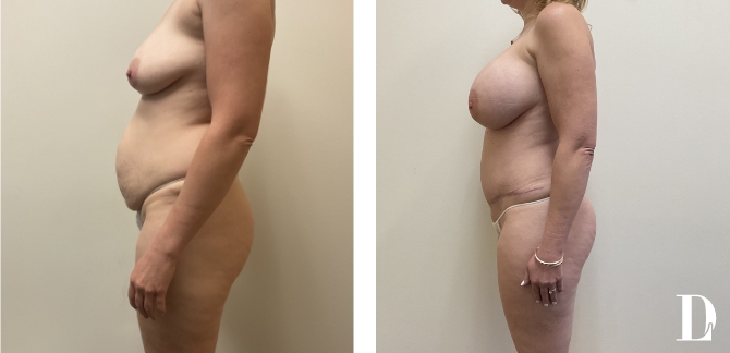 Tummy Tuck & Breast Augmentation before and after - before
