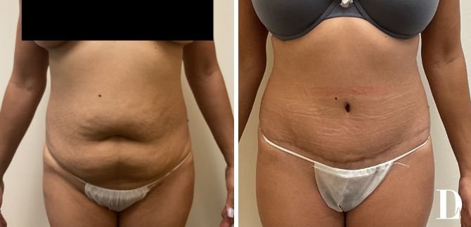 Tummy Tuck before and after - before