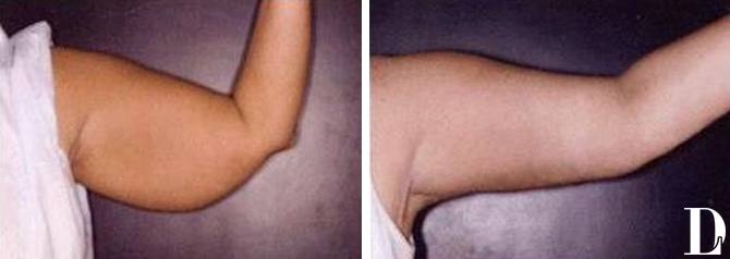 Arm Lift before and after - before