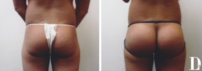 Butt Implant Surgery before and after - before