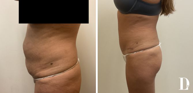 Tummy Tuck before and after - before