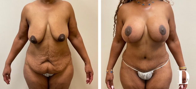 Tummy Tuck, Breast Augmentation, and Mastopexy before and after - before