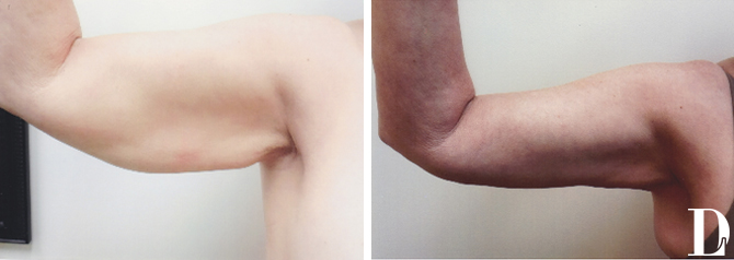 Arm Lift before and after - before