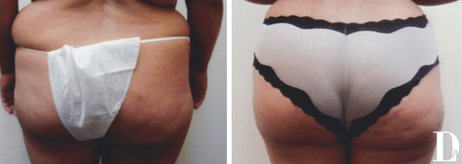 Brazilian Butt Lift before and after - before