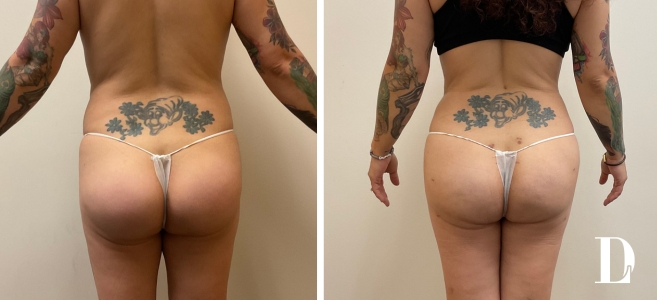 Butt Implant Removal with Liposuction and Fat Transfer before and after - before