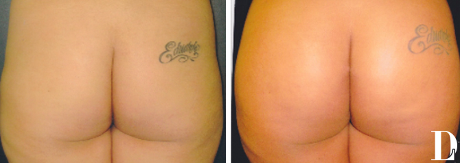 Brazilian Butt Lift before and after - before